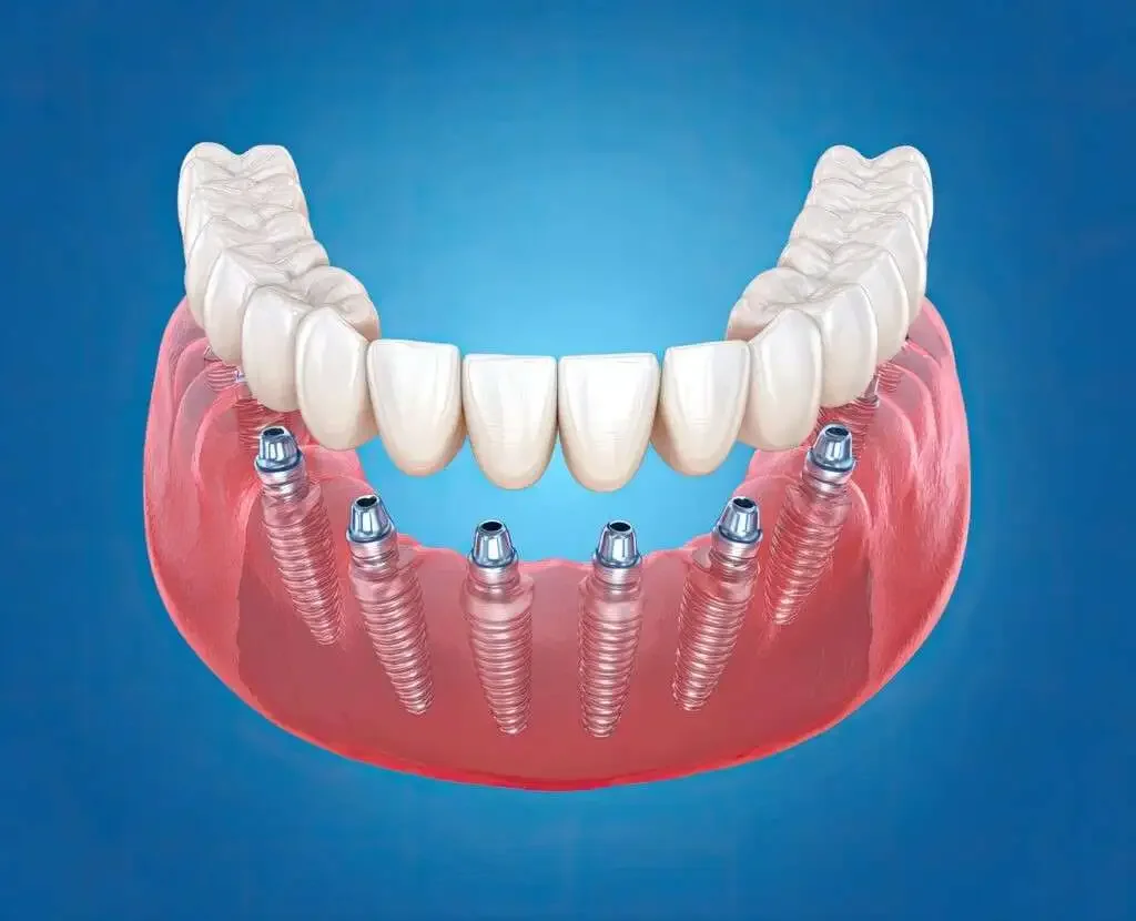 All-on-X Dental Implants: What to Know Before Replacing Most or All of Your Teeth