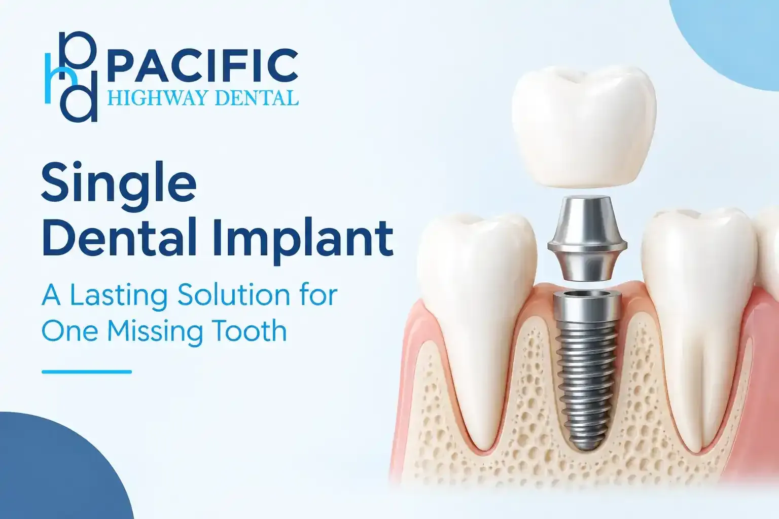 Single Tooth Implant in Kent WA