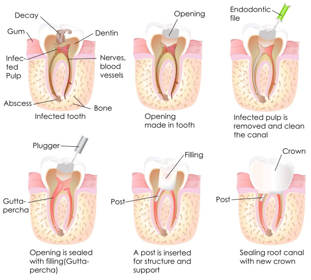 Root-Canal